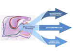 Clinical implications of intra-tumour heterogeneity in colon cancer